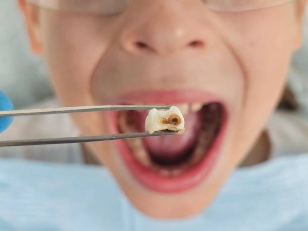 Best Emergency Wisdom Tooth Extraction in Tlassee, AL